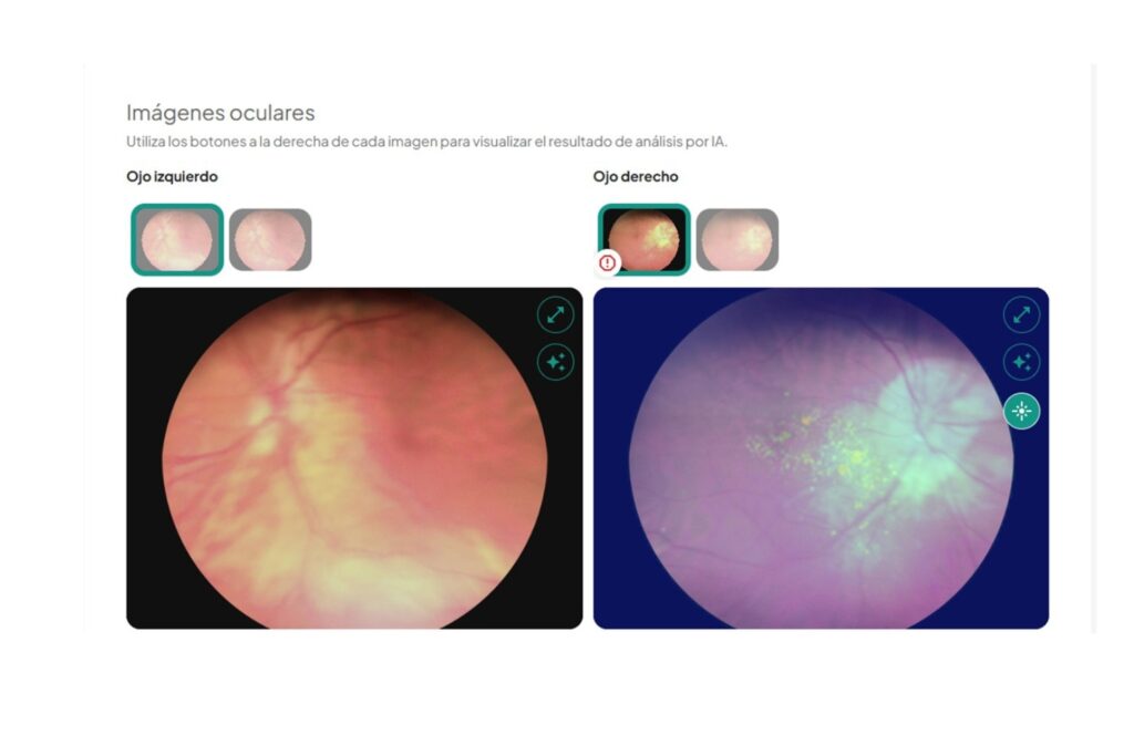 Estudio de Retina con Inteligencia Artificial en CDMX